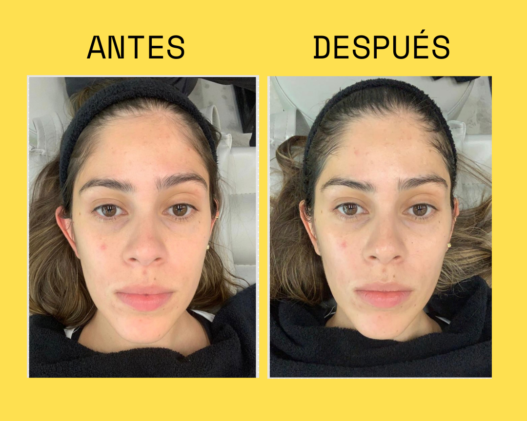 Resultado antes y después