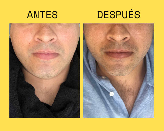 Resultado antes y después